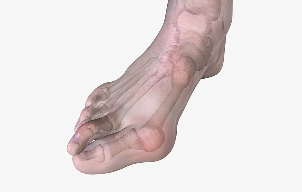 Κότσι: Τι είναι και πώς μπορούν να βοηθήσουν τα ιατρικά βοηθήματα