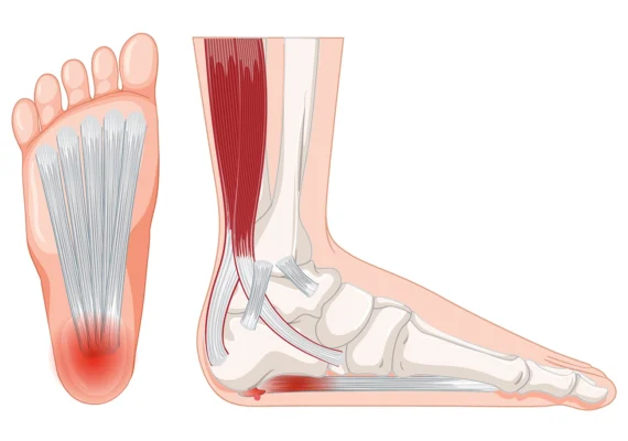Πελματιαία Απονευρωσίτιδα: Αίτια, Αντιμετώπιση και Ορθοπαιδικές Λύσεις