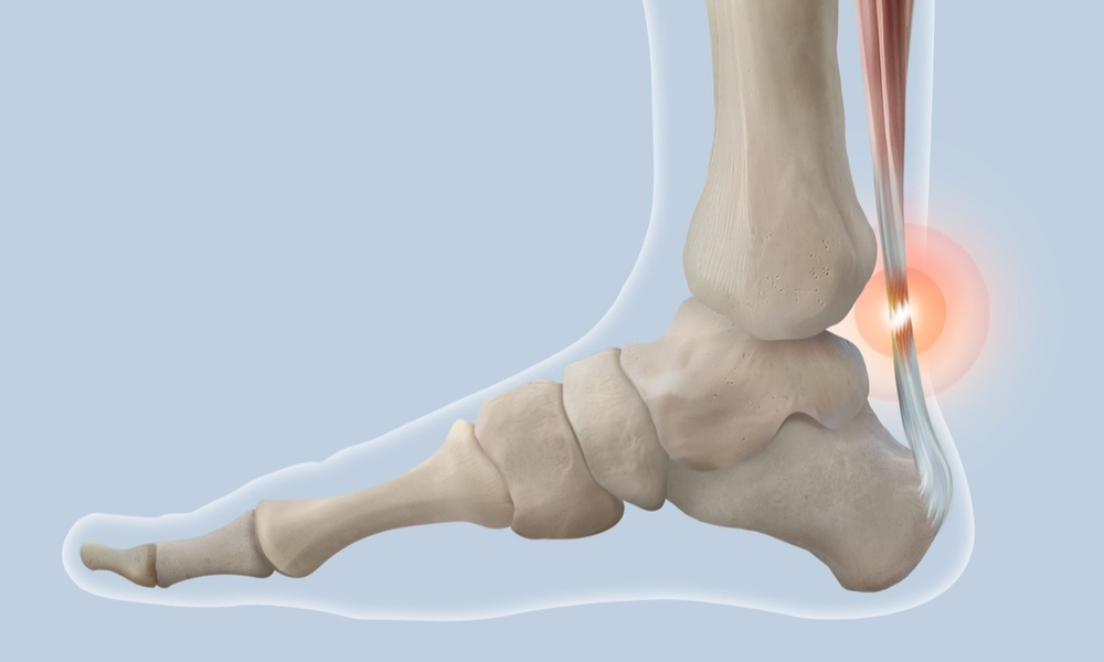 Αχίλλειος Τένοντας